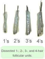 Dissected Follicular Units - Hair Transplant Manila Philippines by Manzanares Hair Restoration Center