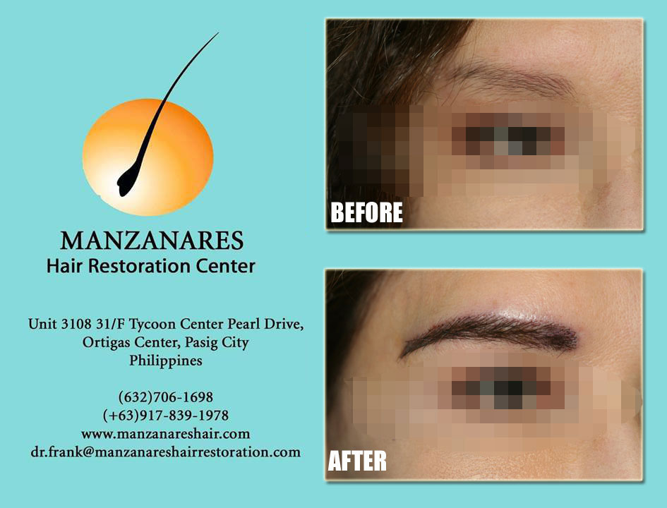 Eyebrow Hair Transplant Manila Philippines by Manzanares Hair Restoration Center