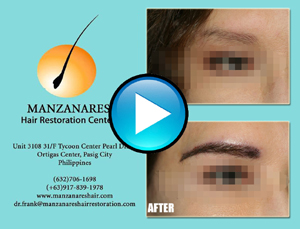 Eyebrow Hair Transplant Manila Philippines by Manzanares Hair Restoration Center