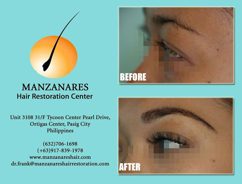 Eyebrow Hair Transplant Manila Philippines by Manzanares Hair Restoration Center