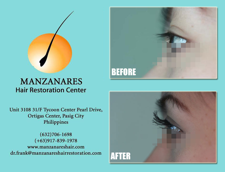 Eyebrow Hair Transplant for Men Manila Philippines by Manzanares Hair Restoration Center