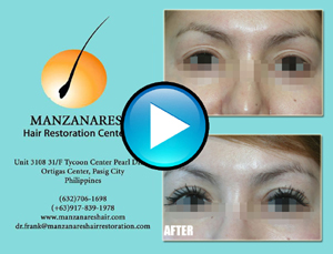Eyelash Hair Transplant Procedure by Manzanares Hair Restoration Center