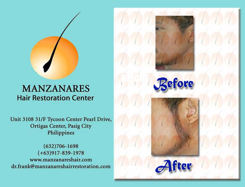Facial Hair Transplant by Manzanares Hair Restoration Center
