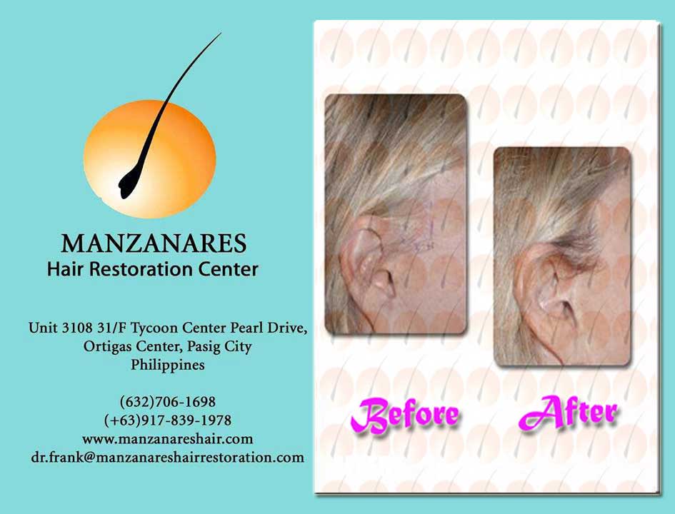 Facial Hair Transplant (Sideburns) by Manzanares Hair Restoration Center