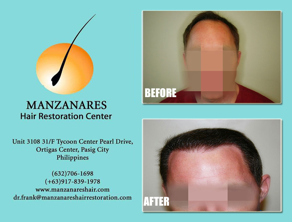 Hair Transplant for Men Manila Philippines by Manzanares Hair Restoration Center