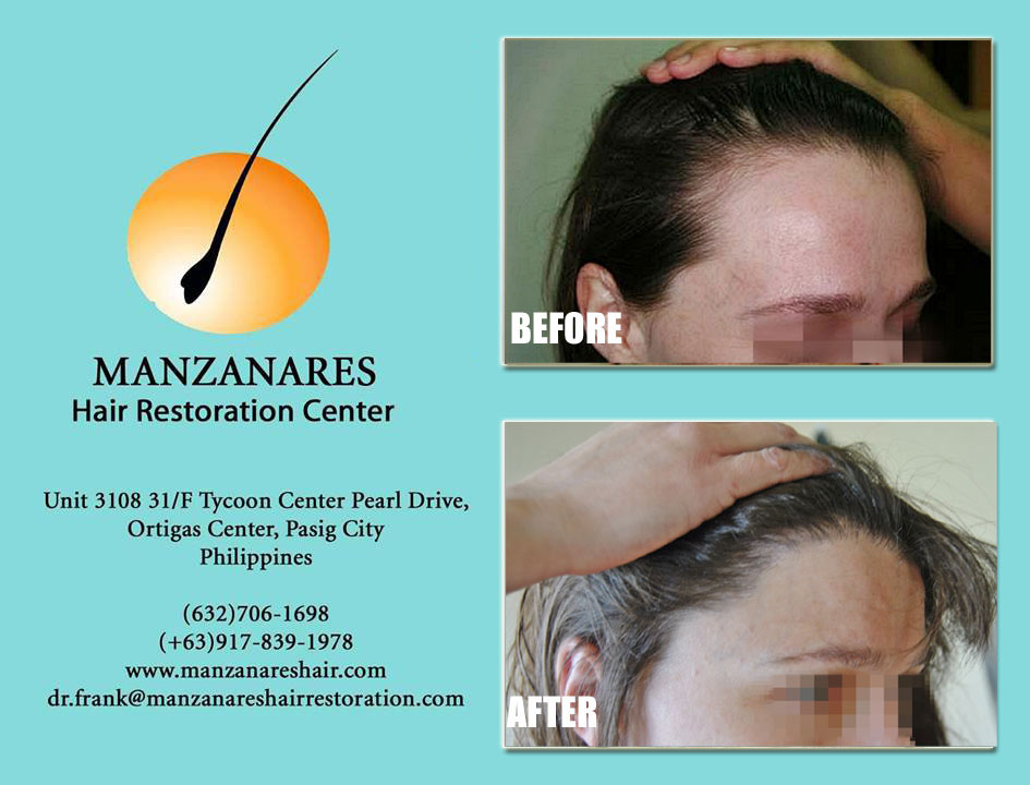 Hair Transplant for Women Manila Philippines by Manzanares Hair Restoration Center