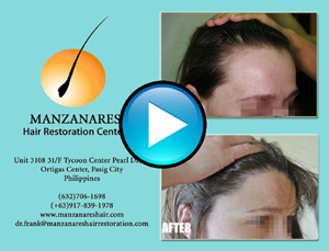 Hair Transplant Manila Philippines by Manzanares Hair Restoration Center