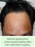 Hairline After Restoration - Hair Transplant Manila Philippines by Manzanares Hair Restoration Center