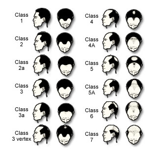 Norwoord-Hamilton Scale for Men's Hair Loss Hair Transplant Manila Philippines by Manzanares Hair Restoration Center