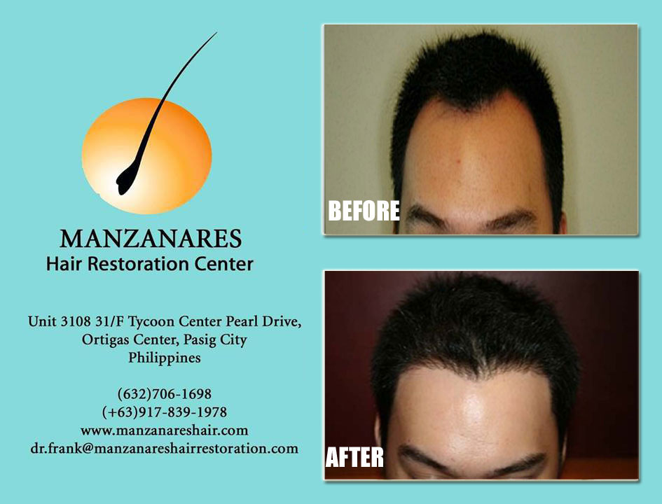 Hair Transplant Before and After Photos - Manzanares Hair Restoration Center
