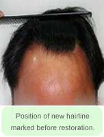  Position of New Hairline Marked Before Restoration - Hair Transplant Manila Philippines by Manzanares Hair Restoration Center