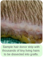 Sample Hair Donor Strip with Thousands of Tiny Living Hairs - Hair Transplant Manila Philippines by Manzanares Hair Restoration Center