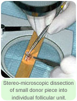 Stereo Microscopic Dissection of Small Donor Piece Into Individual Follicular Unit - Hair Transplant Manila Philippines by Manzanares Hair Restoration Center