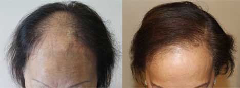 Female Hair Loss Treatment - Women Hair Loss - Manzanares Hair Restoration  Center